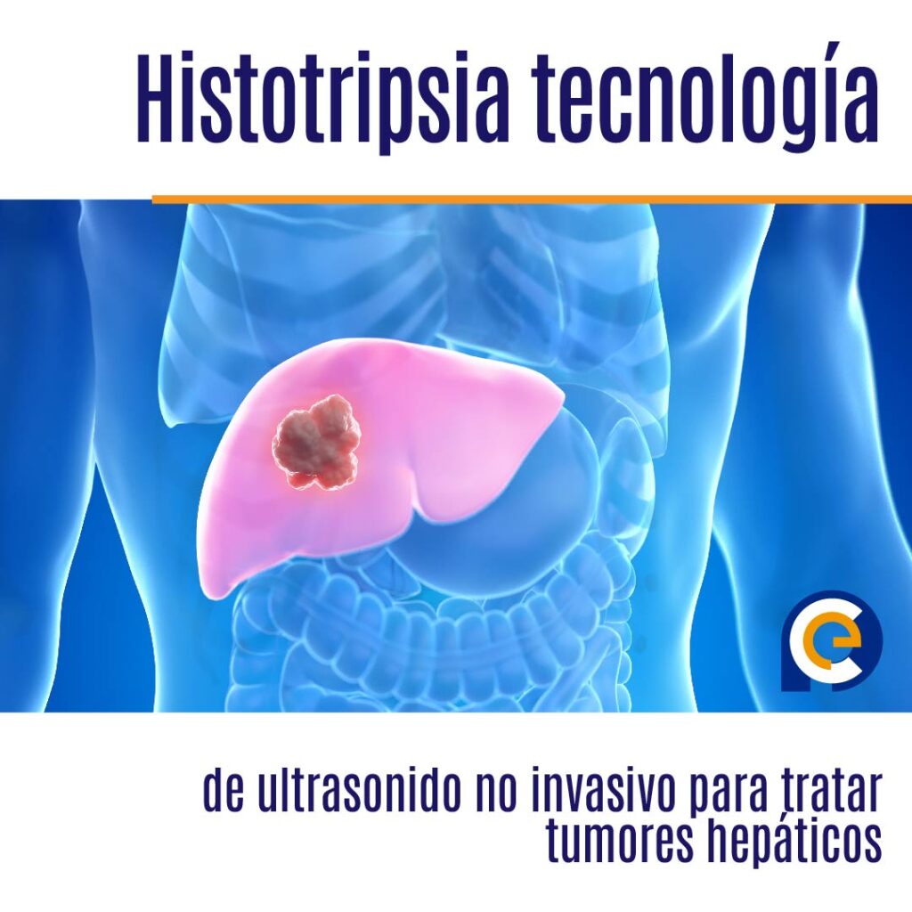 Histotripsia tecnología de ultrasonido no invasivo para tratar tumores hepáticos